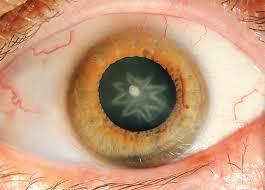 cataract stellate symptomen wat